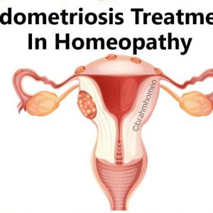 Endometriosis Treatment In Homeopathy